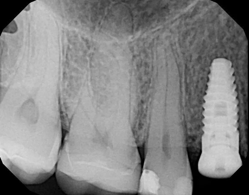 X-ray after implant placement: Implant + Esthetic Crown: Janissa