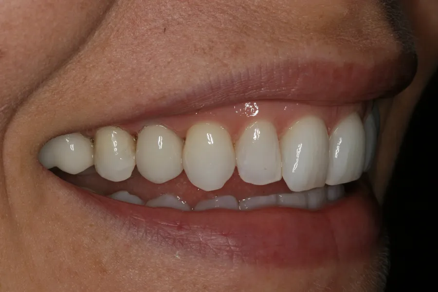 After, Implant + Esthetic Crown: Janissa