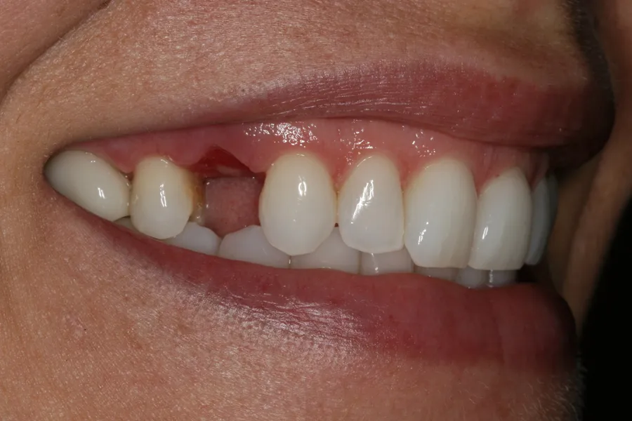 Before, Implant + Esthetic Crown: Janissa