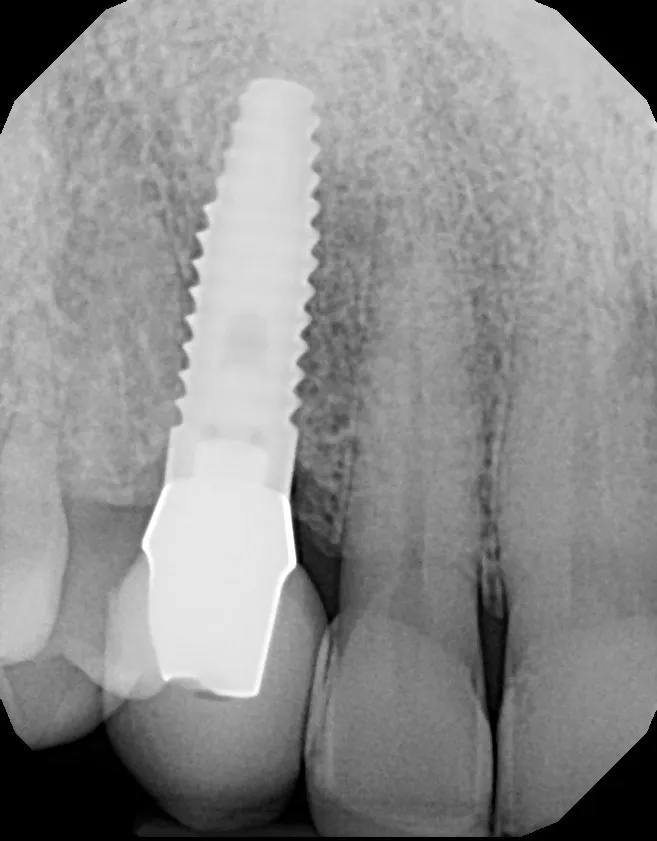 Implant X-ray: 2 Implants + 4 Veneers: Jeff