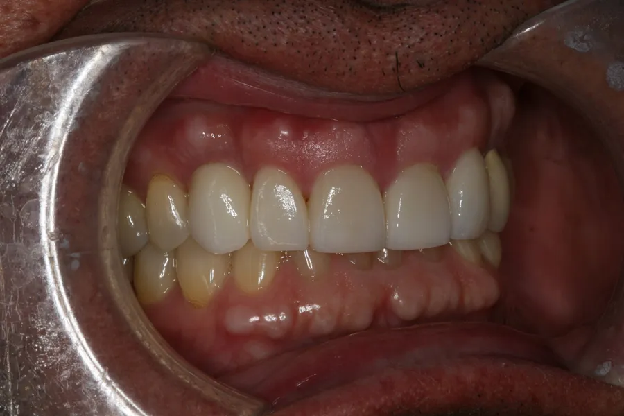 After, 2 Implants + 4 Veneers: Jeff