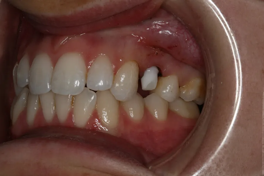Zirconia abutment in place: Implant + Esthetic Crown: Lizzy