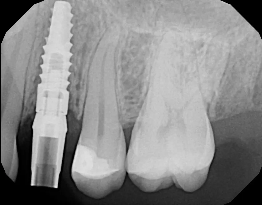 X-ray of the implant: Implant + Esthetic Crown: Lizzy