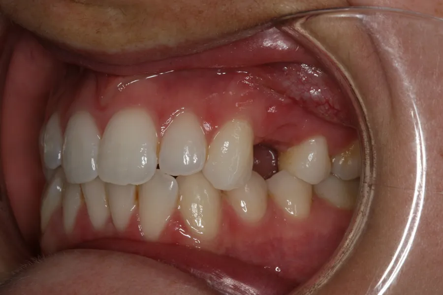 Before, Implant + Esthetic Crown: Lizzy