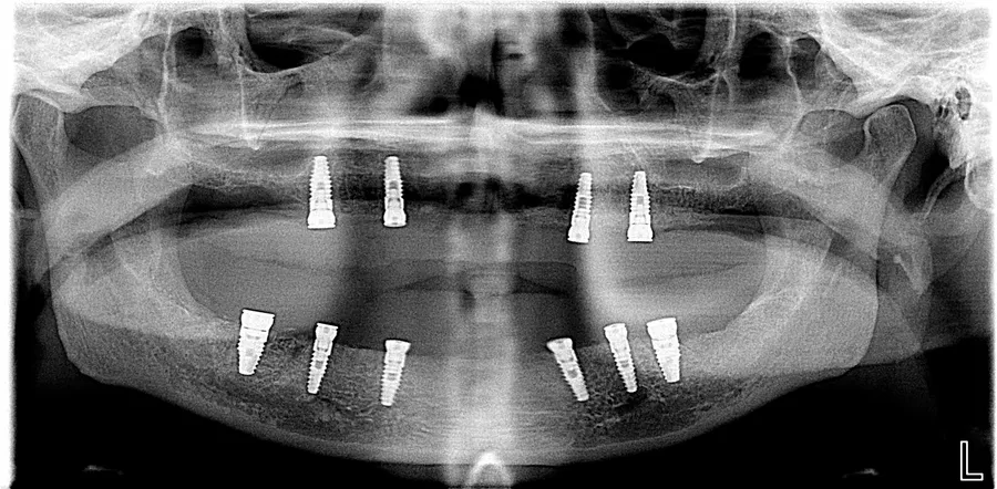 Panoramic X-ray, after: Full-Mouth Locator Dentures: Lori