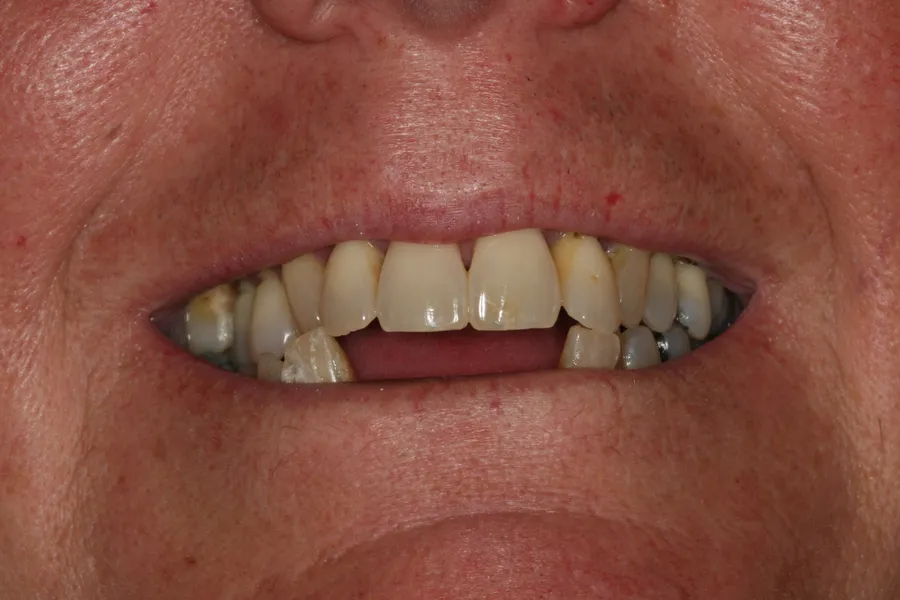 Before, Full-Mouth Locator Dentures: Lori