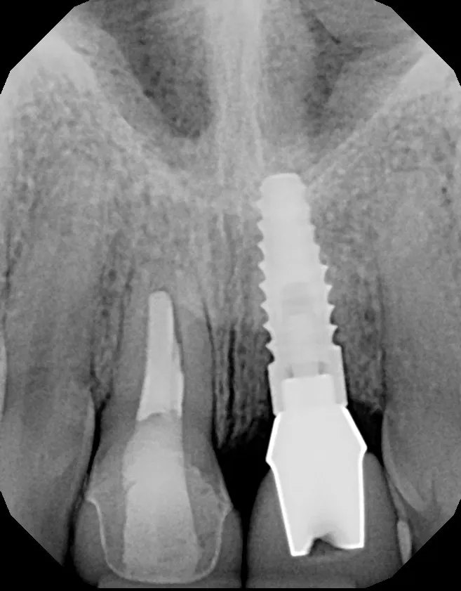 X-ray after implant placement: Implant + Esthetic Crown: Maddi