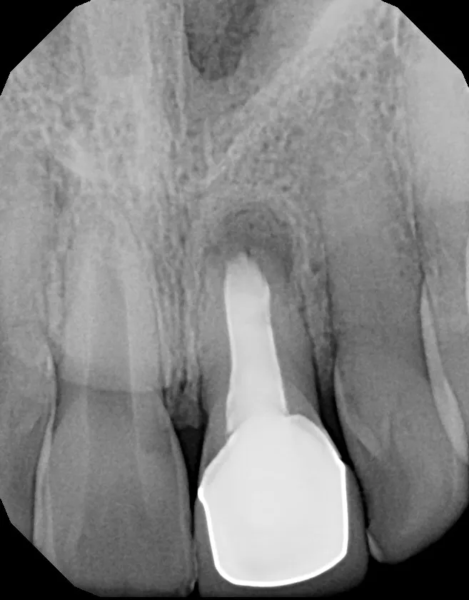 X-ray before treatment: Implant + Esthetic Crown: Maddi