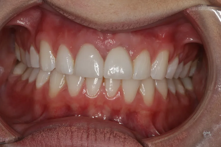 After, Implant + Esthetic Crown: Maddi