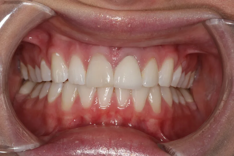 Before, Implant + Esthetic Crown: Maddi