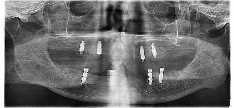Panoramic X-ray, after: Upper & Lower Locator Dentures: Mark