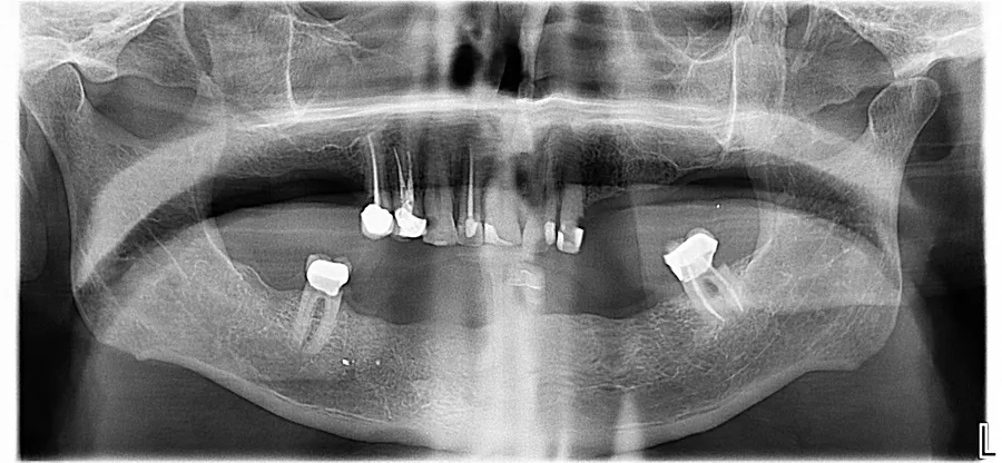 Panoramic X-ray, before: Upper & Lower Locator Dentures: Mark