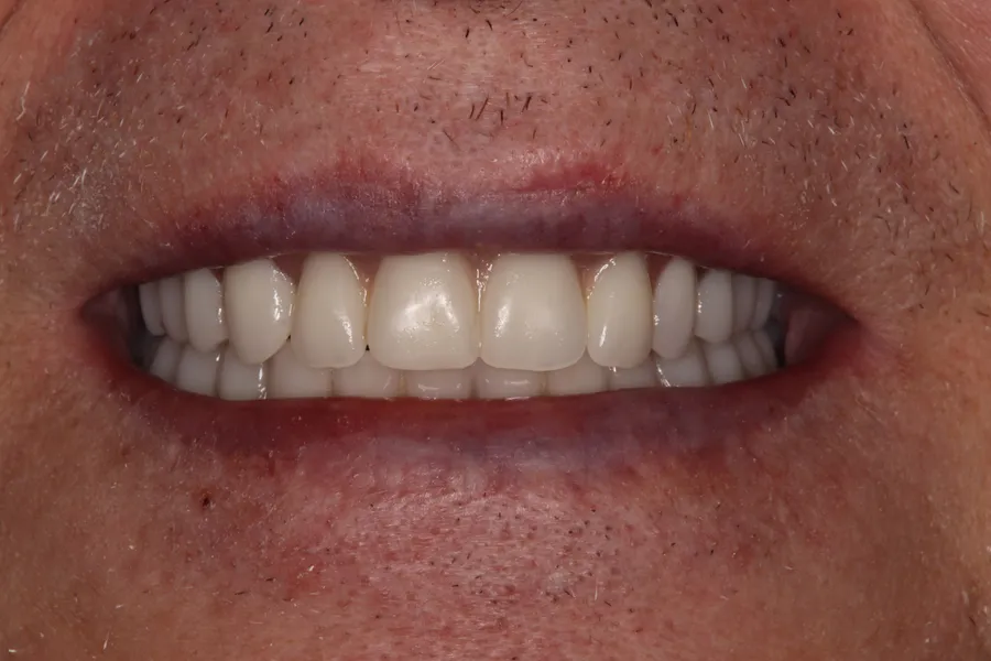After (close-up), Upper & Lower Locator Dentures: Mark