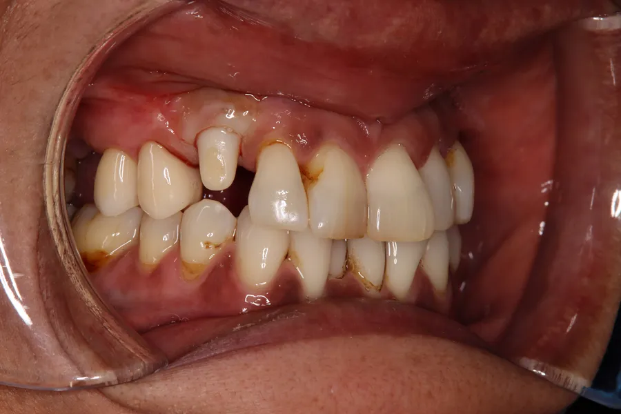 Zirconia abutment in place: Implant for a Failing Cuspid: Mary