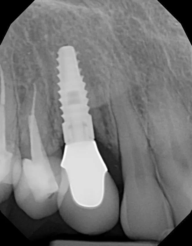 X-ray of the completed implant: Implant for a Failing Cuspid: Mary