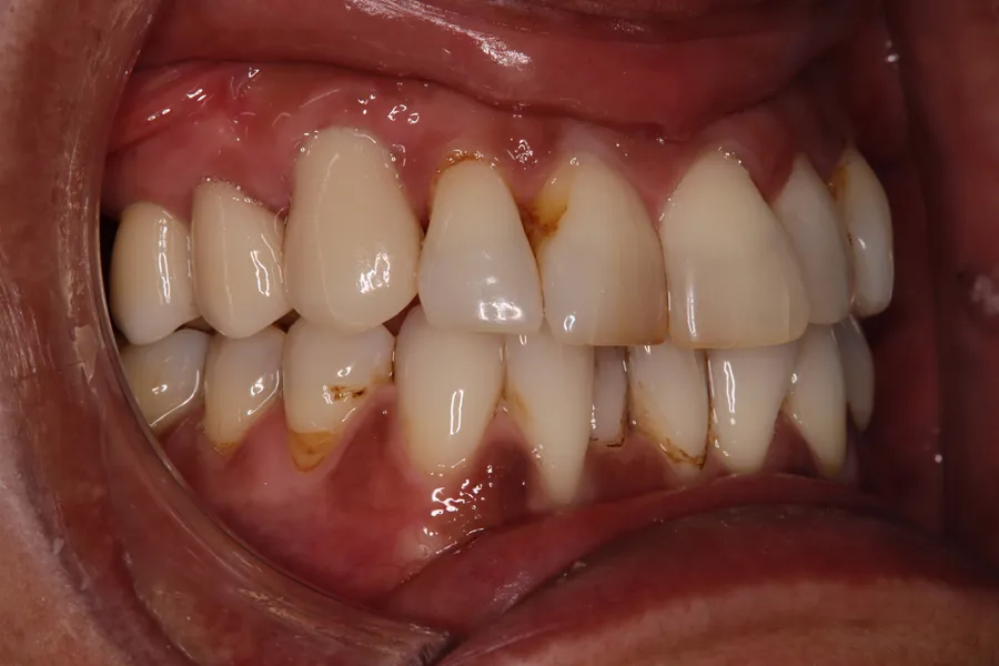 After, Implant for a Failing Cuspid: Mary