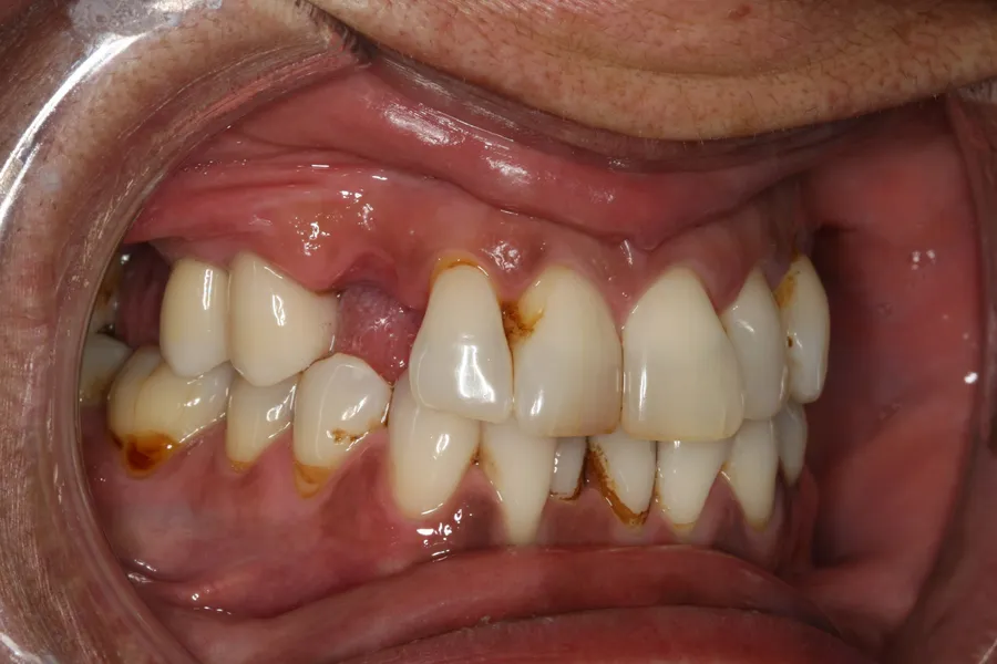 Before, Implant for a Failing Cuspid: Mary