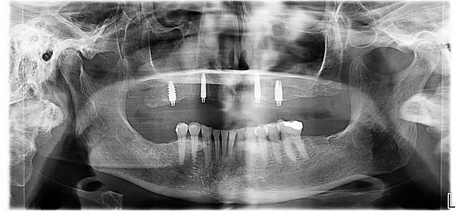 Panoramic X-ray, after: Upper Locator Denture: Maurie