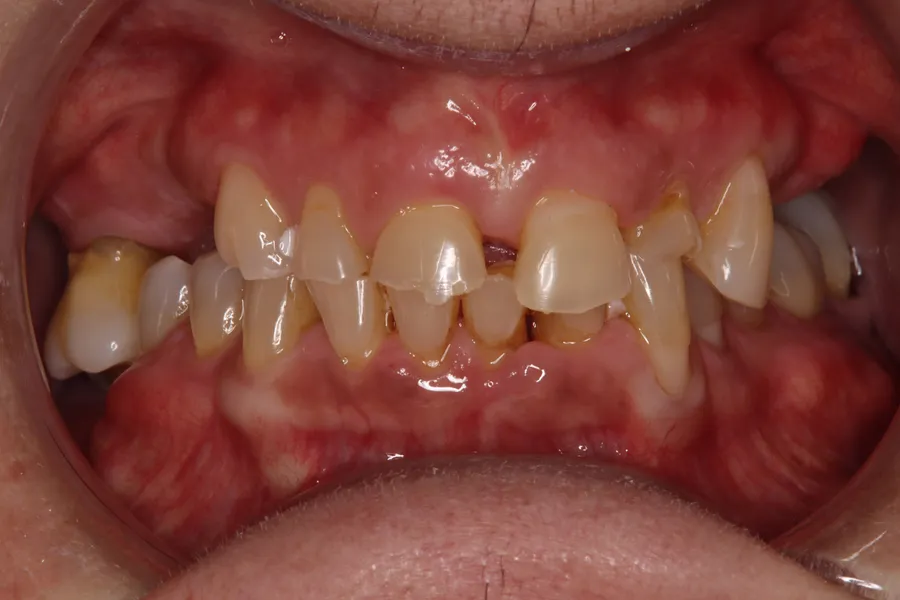 Retracted view, before: Upper Locator Denture: Maurie