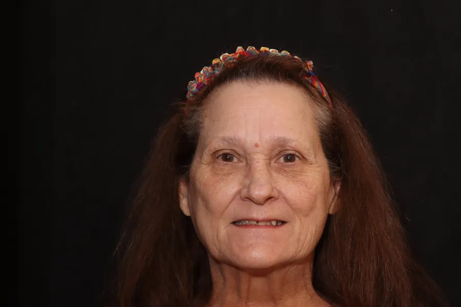 Before, Upper Locator Denture: Maurie