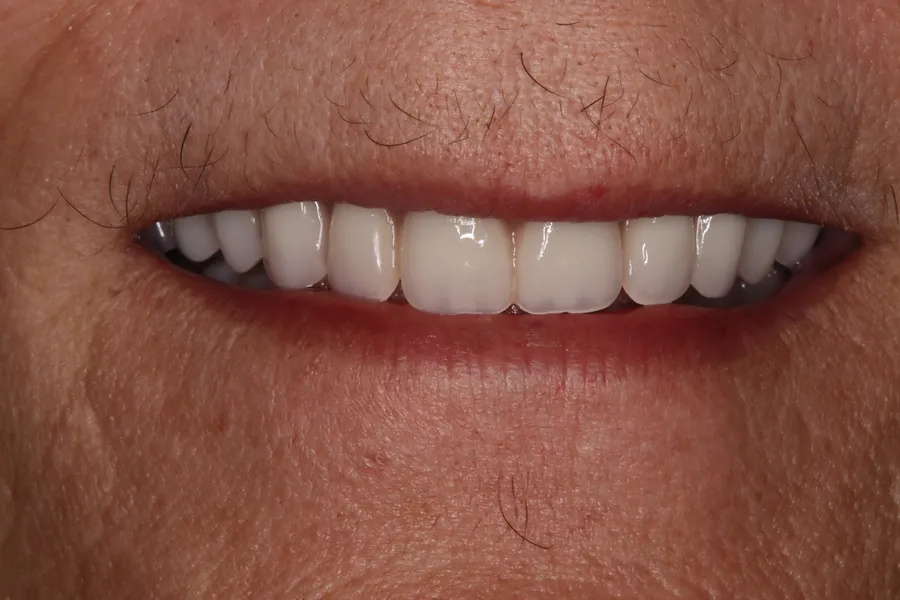 After (close-up), Upper Locator Denture: Maurie