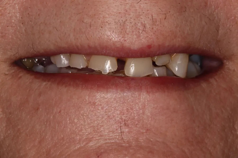Before (close-up), Upper Locator Denture: Maurie