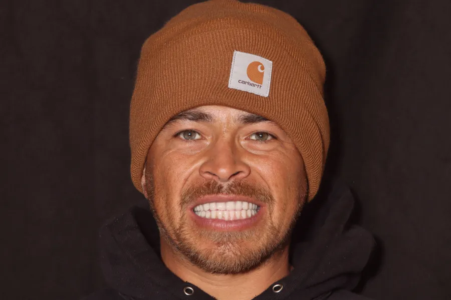 After, Full-Mouth Locator Dentures: Miguel