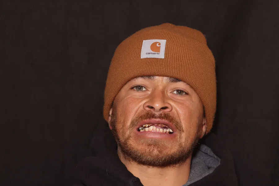 Before, Full-Mouth Locator Dentures: Miguel
