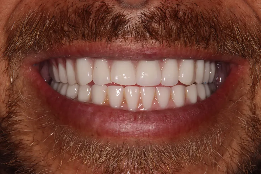 After (close-up), Full-Mouth Locator Dentures: Miguel
