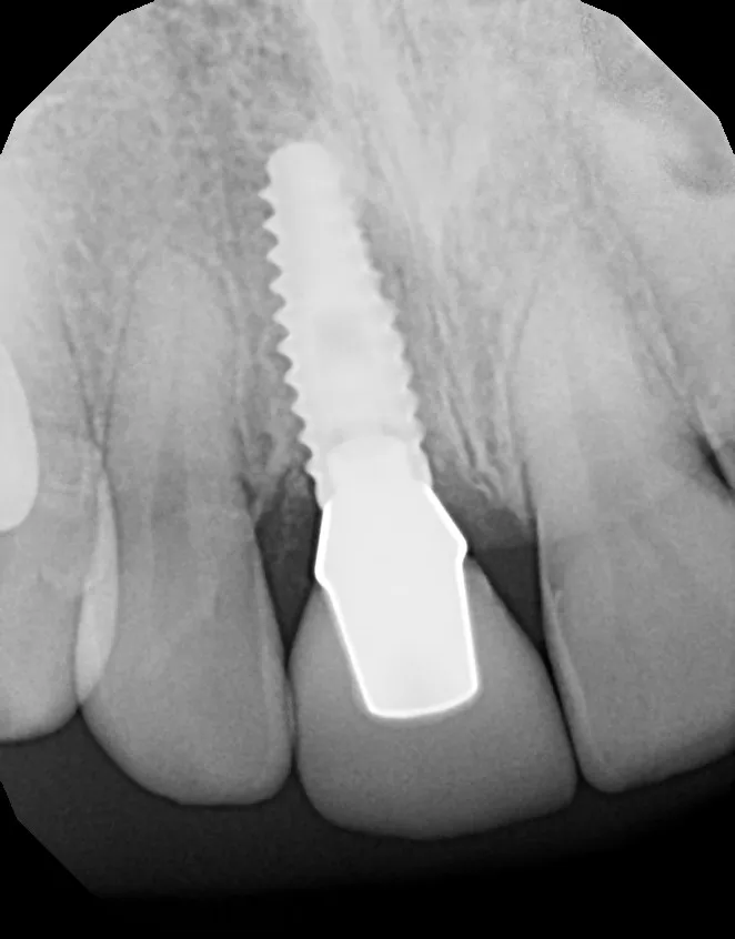 X-ray after implant placement: Same-Day Implant for a Fractured Tooth: Nick