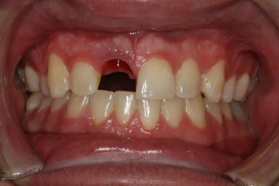 Before, Same-Day Implant for a Fractured Tooth: Nick