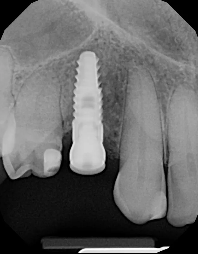 Implant X-ray: 2 Implants + 4 Veneers: Tina