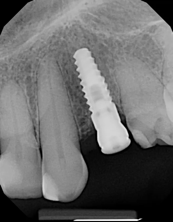 Implant X-ray: 2 Implants + 4 Veneers: Tina