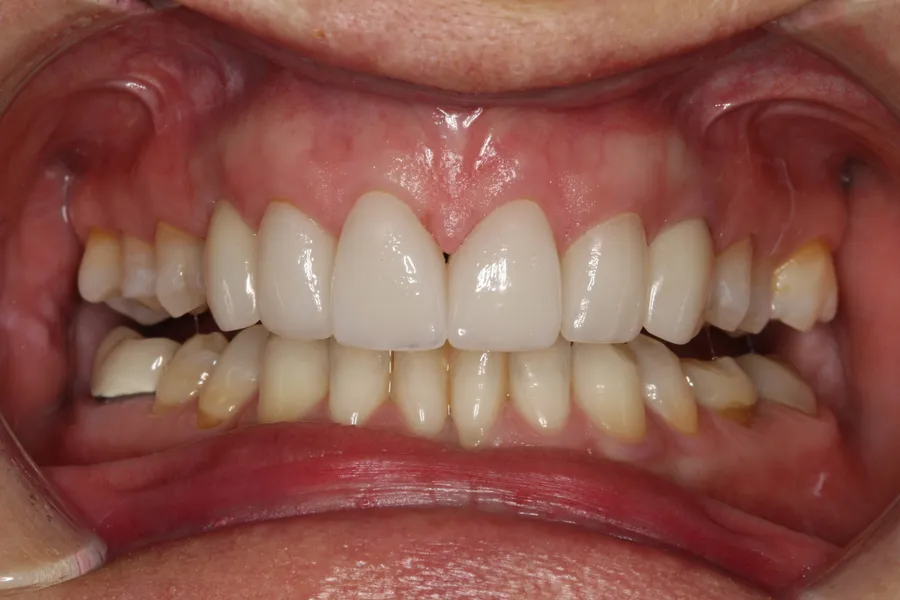 After, 2 Implants + 4 Veneers: Tina