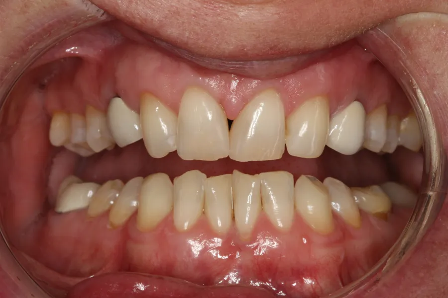 Before, 2 Implants + 4 Veneers: Tina
