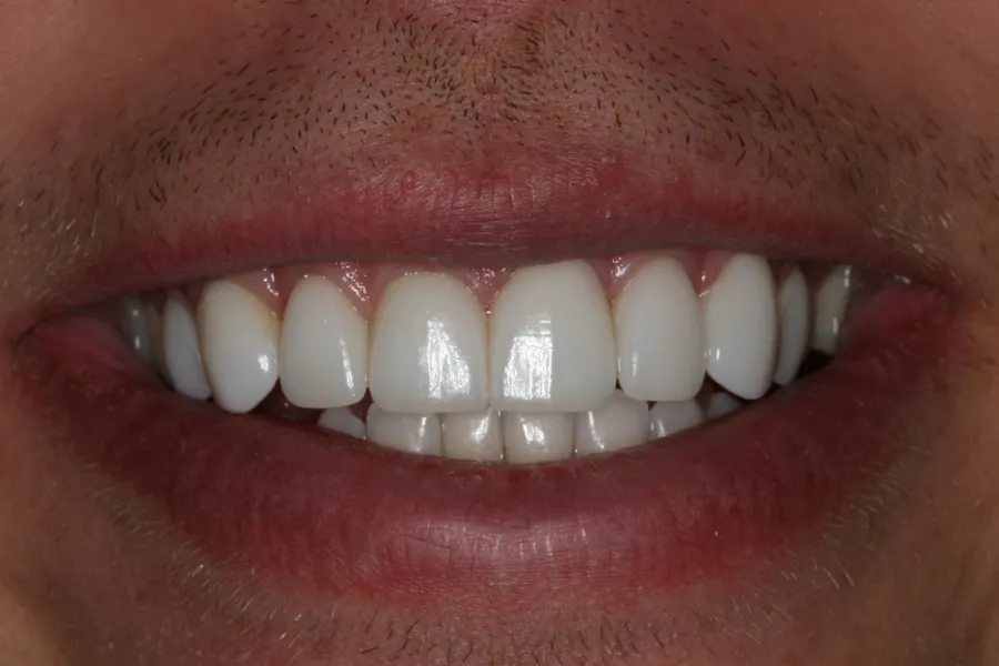 Aaron's smile transformation at Rod Gleave, DMD, after