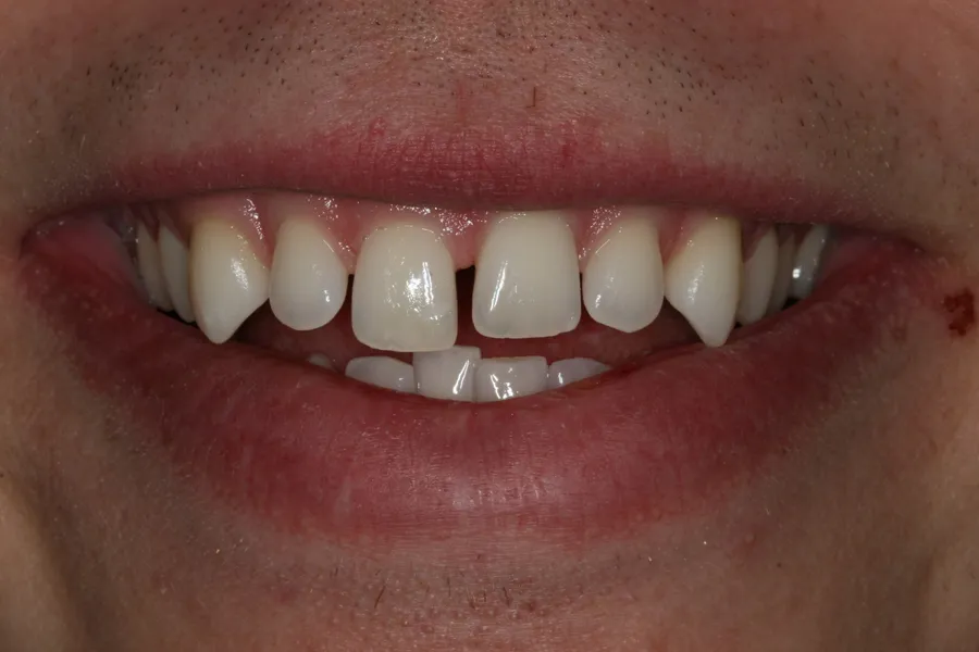 Aaron's smile transformation at Rod Gleave, DMD, before