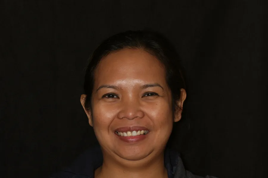 Before, 6 All-Porcelain Esthetic Crowns: Aileen