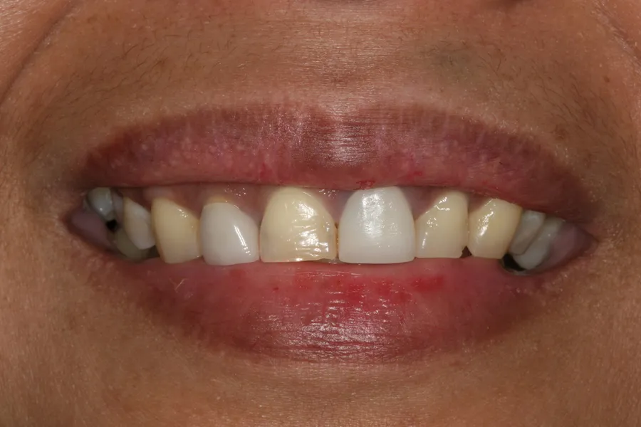 Before (close-up), 6 All-Porcelain Esthetic Crowns: Aileen