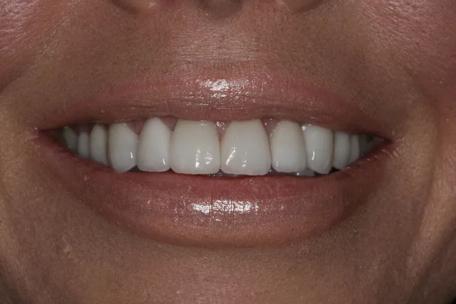 After (close-up), 10 Porcelain Veneers: Ashleigh