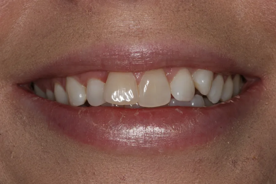 Before (close-up), 10 Porcelain Veneers: Ashleigh