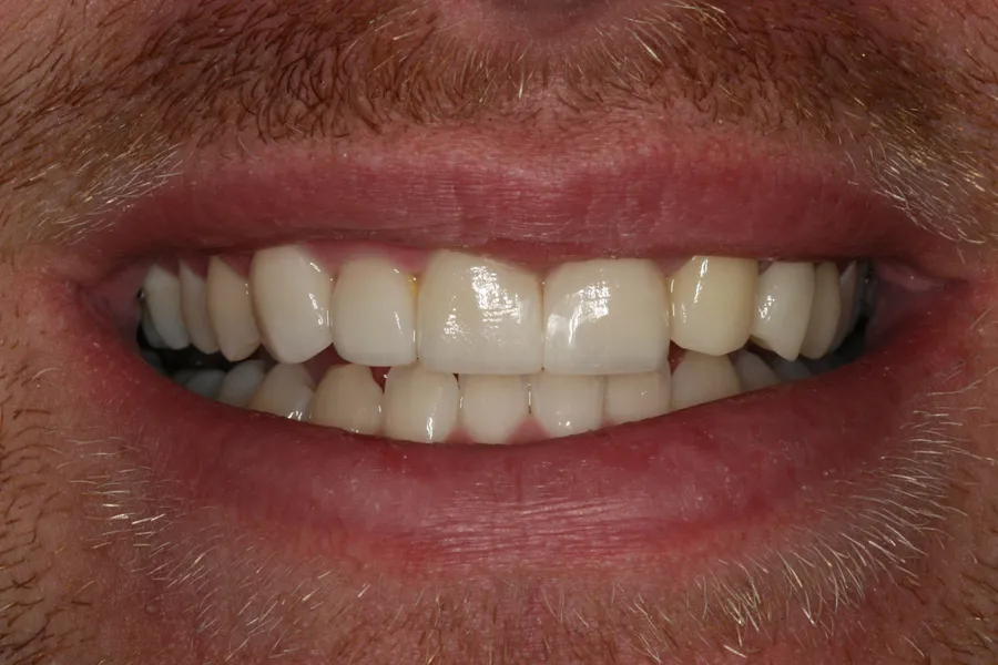 After, 5 Porcelain Veneers: Austin