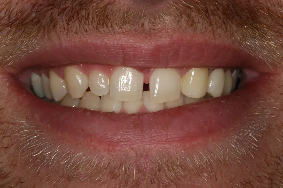 Before, 5 Porcelain Veneers: Austin