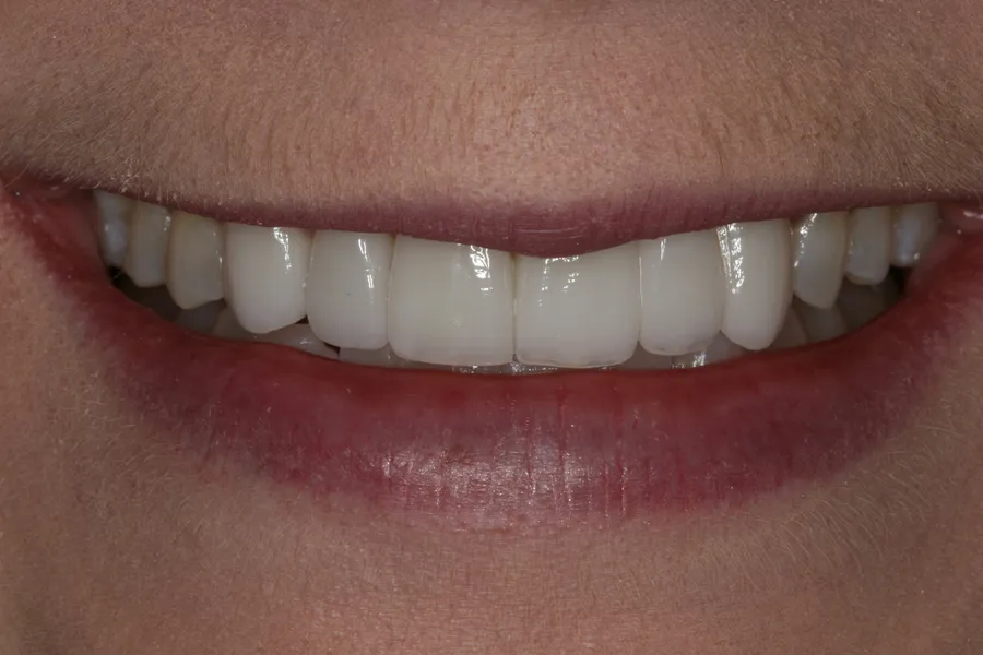 After (close-up), Porcelain Bridge + 3 Veneers: Bridgette