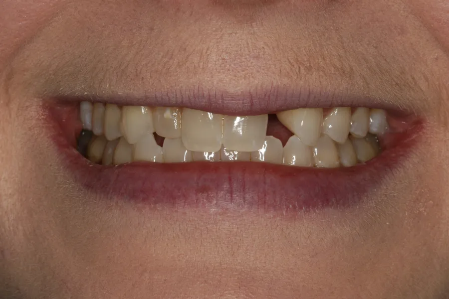 Before (close-up), Porcelain Bridge + 3 Veneers: Bridgette