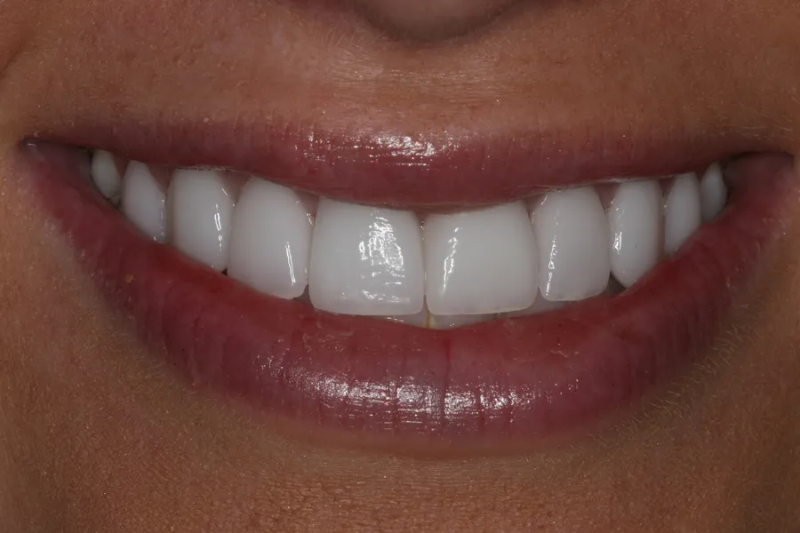 Brittany's smile transformation at Rod Gleave, DMD, after