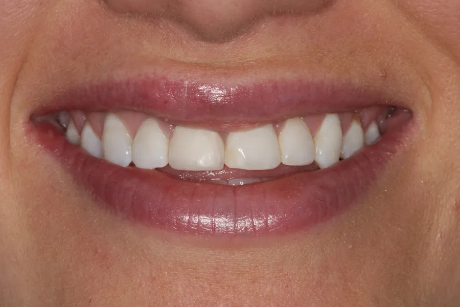 Brittany's smile transformation at Rod Gleave, DMD, before