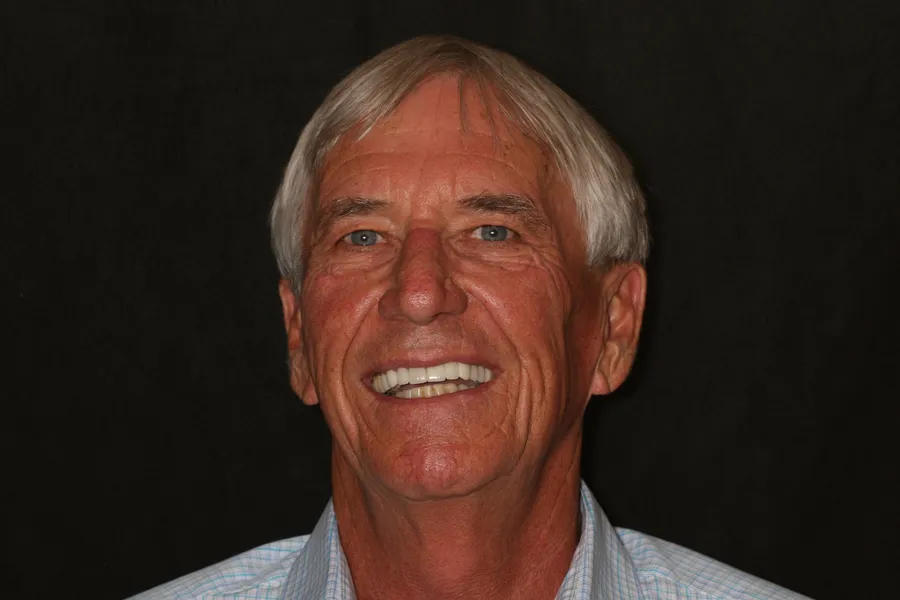 After, Full-Smile Rebuild (20 Teeth): Dale