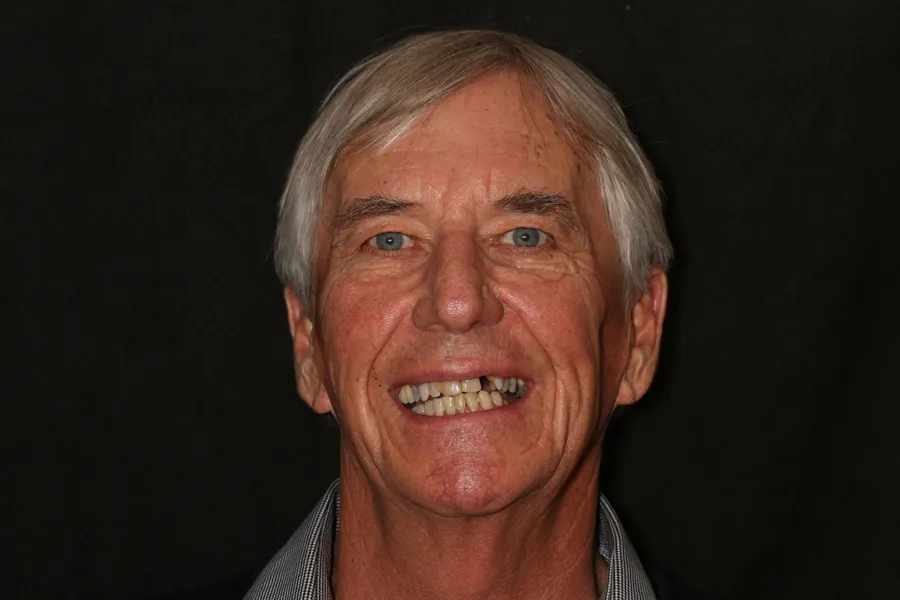 Before, Full-Smile Rebuild (20 Teeth): Dale