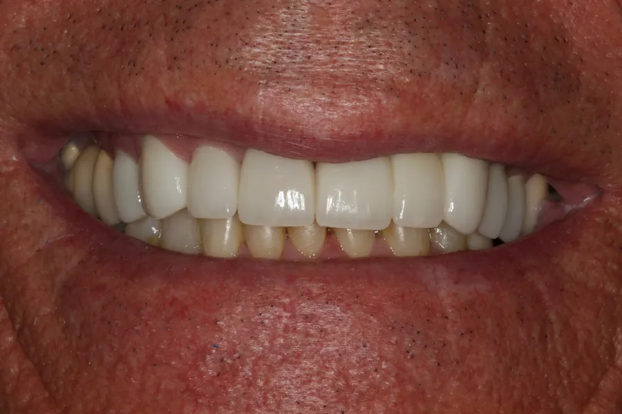 After (close-up), Full-Smile Rebuild (20 Teeth): Dale